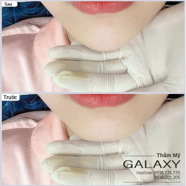 Tiêm filler tại Thẩm mỹ viện Galaxy