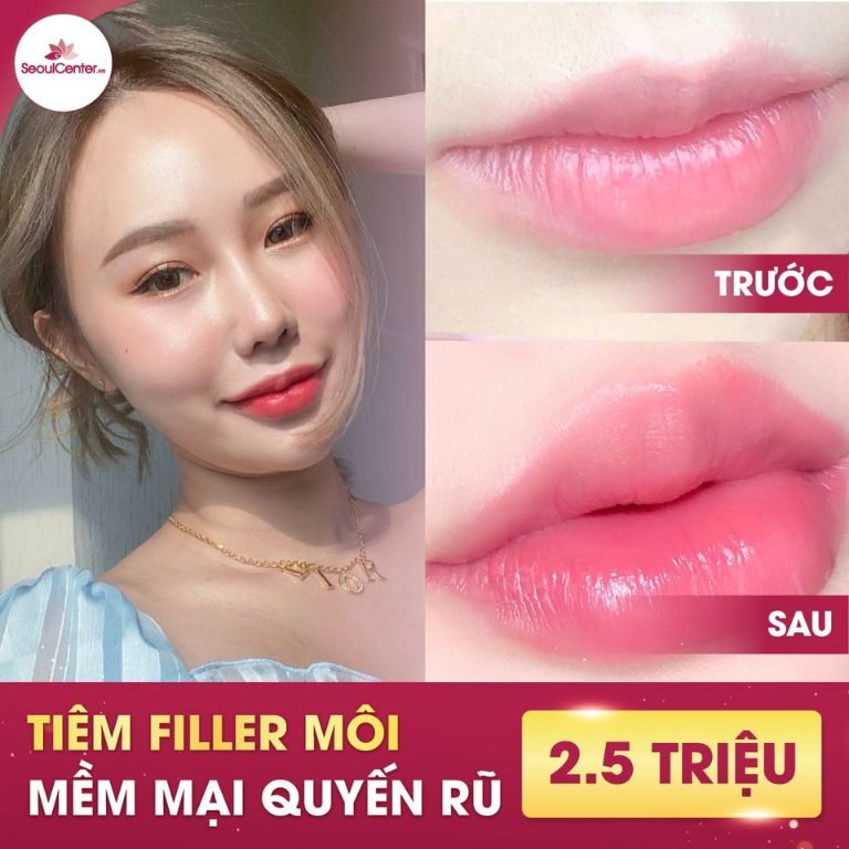 Thẩm mỹ viện Seoul Center tiêm filler môi 