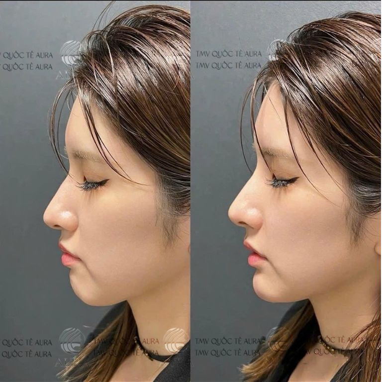 Thẩm Mỹ Viện Quốc Tế Aura tiêm filler