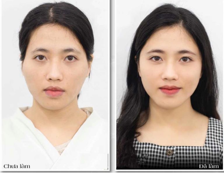 Tạo sự cân đối và trẻ hóa gương mặt