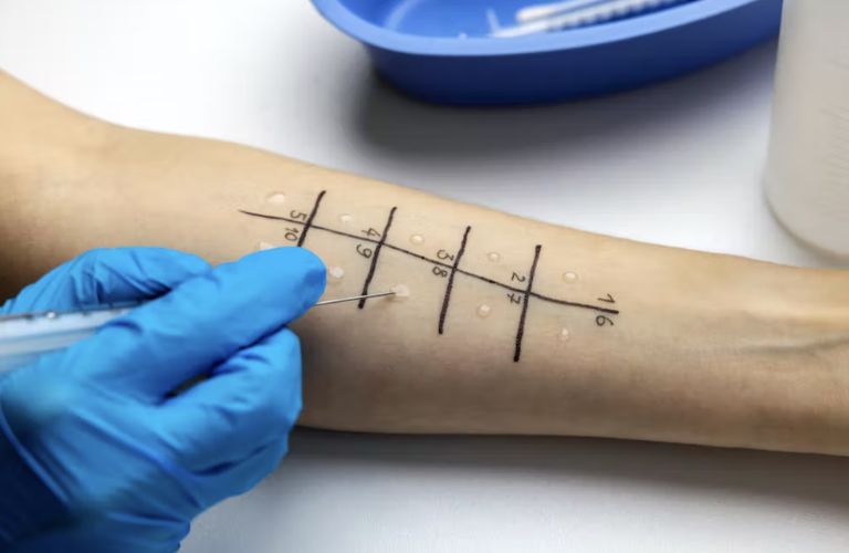Cần test dị ứng trước khi tiêm để tránh những phản ứng dị ứng nghiêm trọng có thể xảy ra