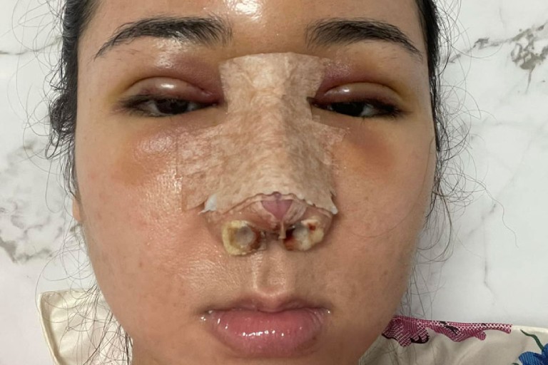 Vì sao vết khâu nâng mũi đóng vảy