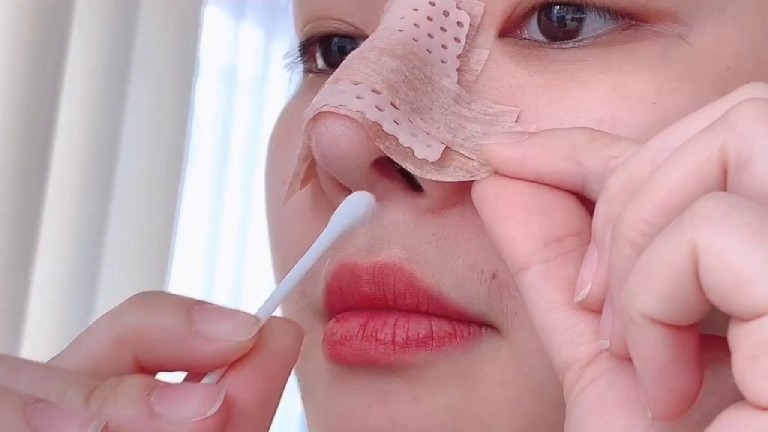 Cách xử lý khi vết khâu nâng mũi đóng vảy
