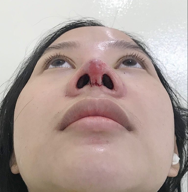 vết khâu nâng mũi đóng vảy bao lâu thì lành