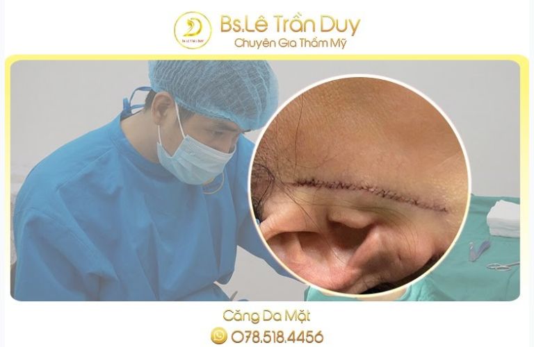 Bác sĩ Lê Trần Duy có hơn 10 năm kinh nghiệm trong lĩnh vực thẩm mỹ, giúp căng da mặt an toàn, hiệu quả, không để lại sẹo xấu