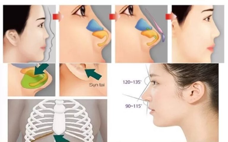 Nâng mũi bọc sụn tự thân