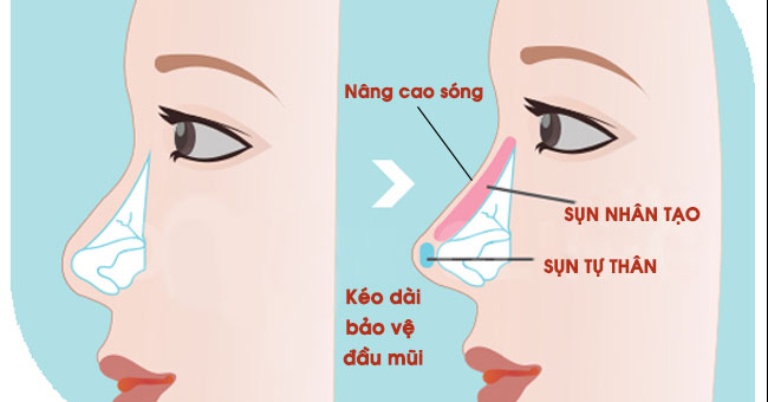 Nâng mũi bọc sụn tự thân có vĩnh viễn không