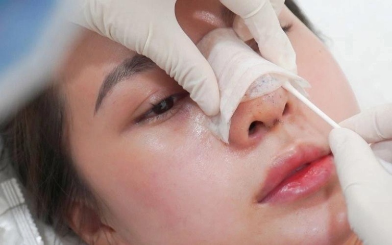 biến chứng do nâng mũi bọc sụn tự thân không đúng kỹ thuật