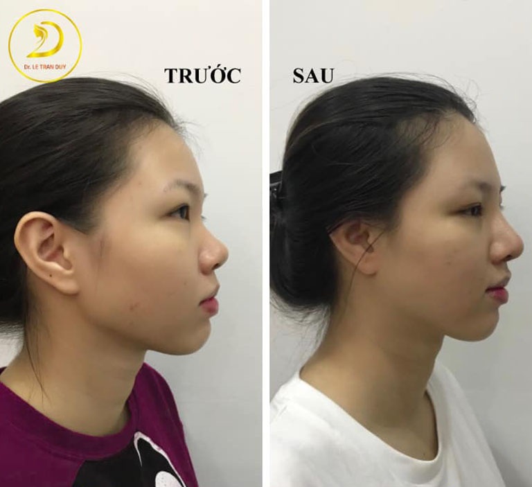 Những đối tượng nên và không nên nâng mũi cấu trúc