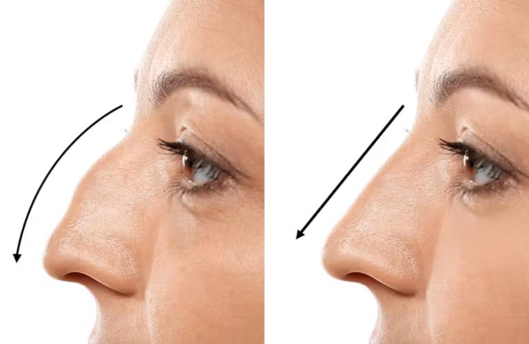 Mũi L Line thẳng gọn nhưng lại thiếu đi sự mềm mại cho những người có phong cách nhẹ nhàng