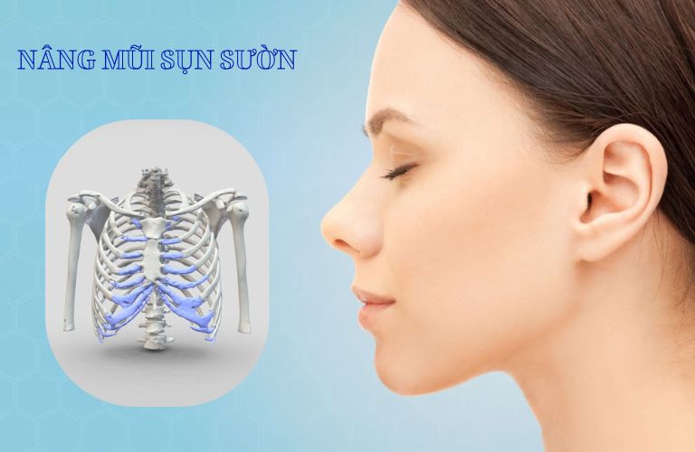 Nâng mũi sụn sườn