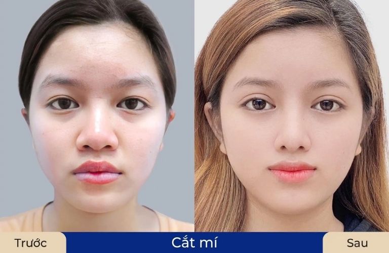 Cắt mí mắt