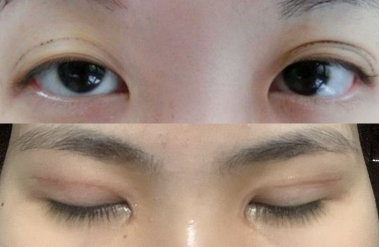 Mắt không đều hoặc mất cân đối