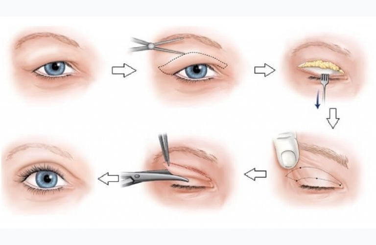 Các bước trong quy trình thực hiện cắt mí mắt chuẩn y khoa