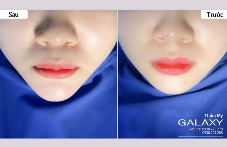 Tiêm filler an toàn, môi mềm nhanh cùng bác sĩ Lê Trần Duy