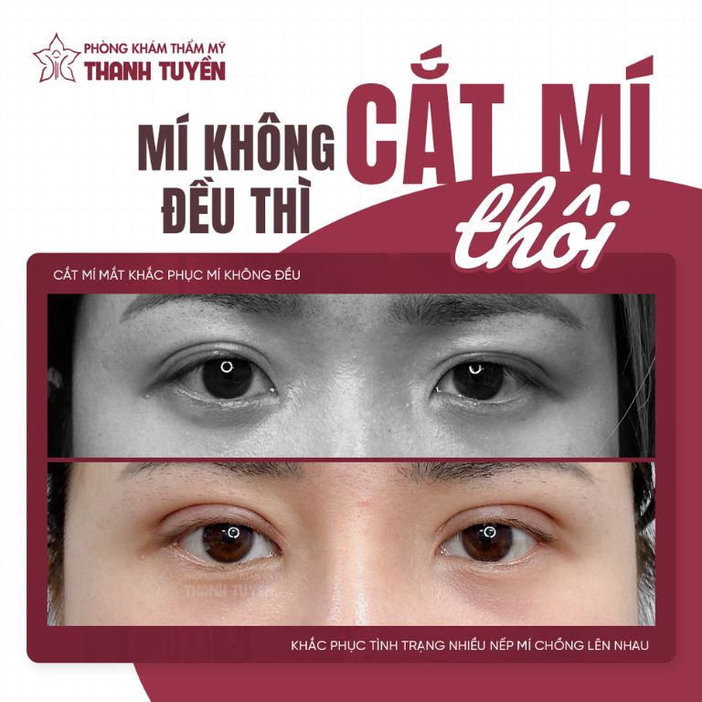 Thẩm Mỹ Viện Thanh Tuyền chuyên cắt mí mắt, sửa mí hỏng