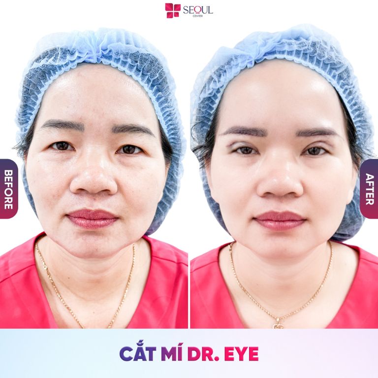 Kỹ thuật cắt mí DR. EYE tại Thẩm mỹ viện Seoul Center