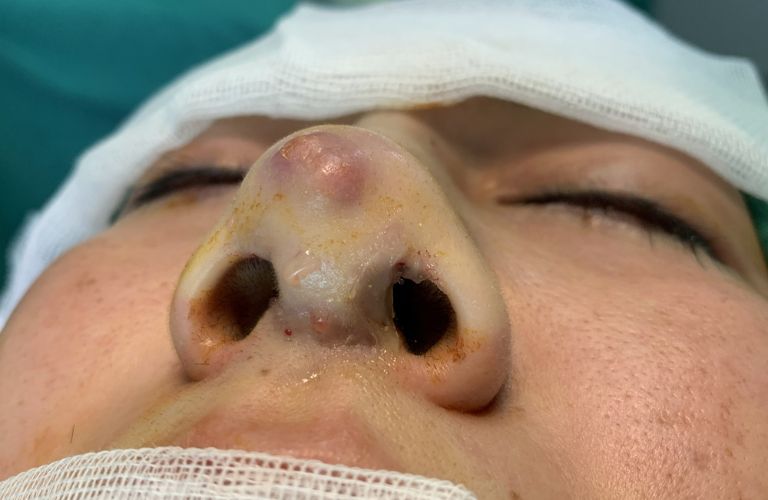 Hỗ trợ sửa mũi bị hỏng miễn phí hàng tháng tại Thẩm mỹ viện Galaxy