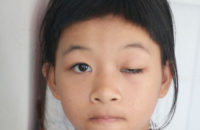 Chỉnh hình mũi miễn phí cho trẻ em dị tật với đội ngũ bác sĩ giỏi