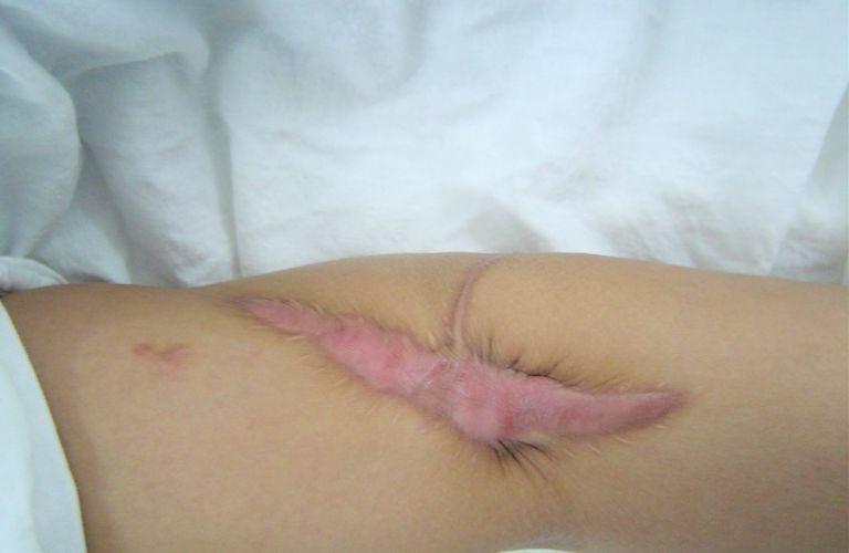 Chương trình trị sẹo miễn phí, khôi phục làn da tại Thẩm mỹ viện Galaxy