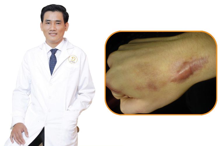 Quy trình trị sẹo miễn phí với bác sĩ Lê Trần Duy