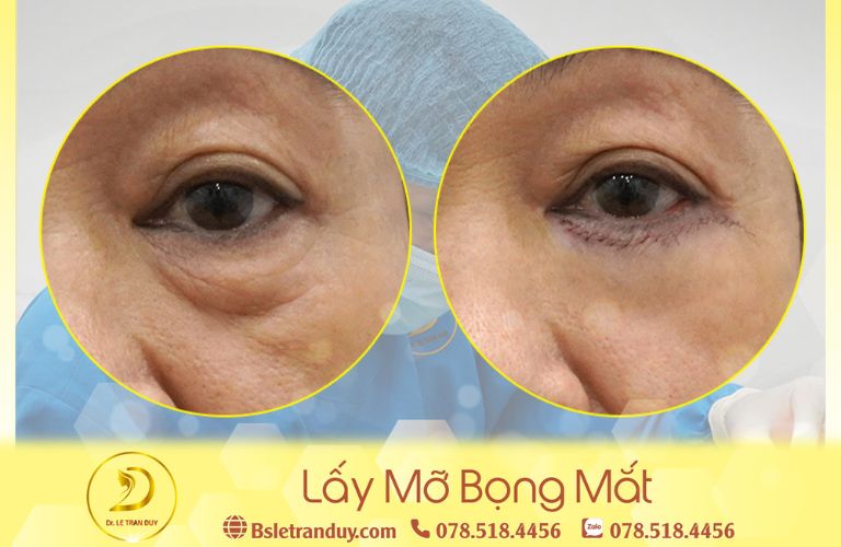 Lão hóa ngược nhờ phương pháp lấy mỡ bọng mắt tại Thẩm mỹ viện Galaxy