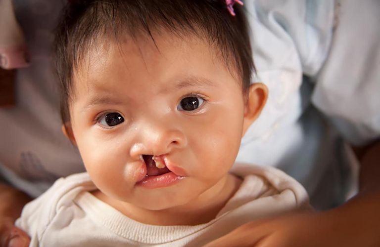 Miễn phí chỉnh sửa sứt môi - hở hàm ếch tại Thẩm mỹ viện Galaxy