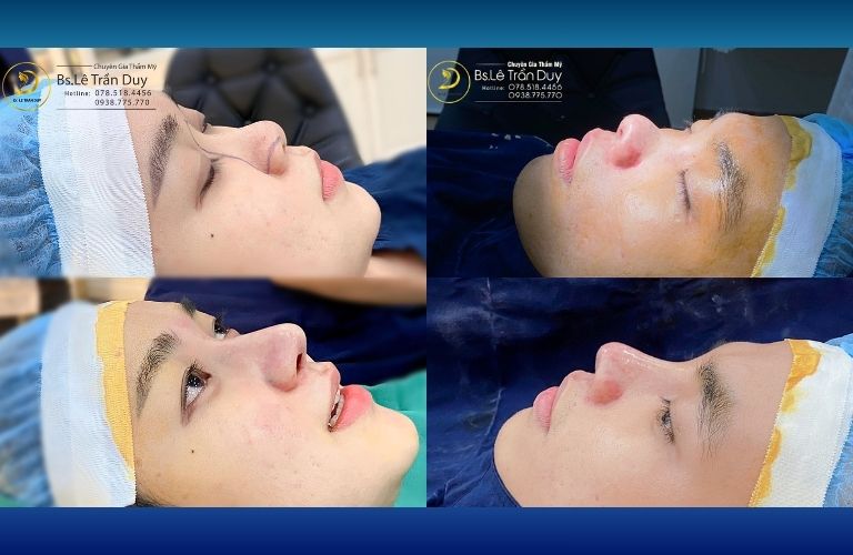 Kết quả sau nâng mũi tại Viện Thẩm mỹ Galaxy