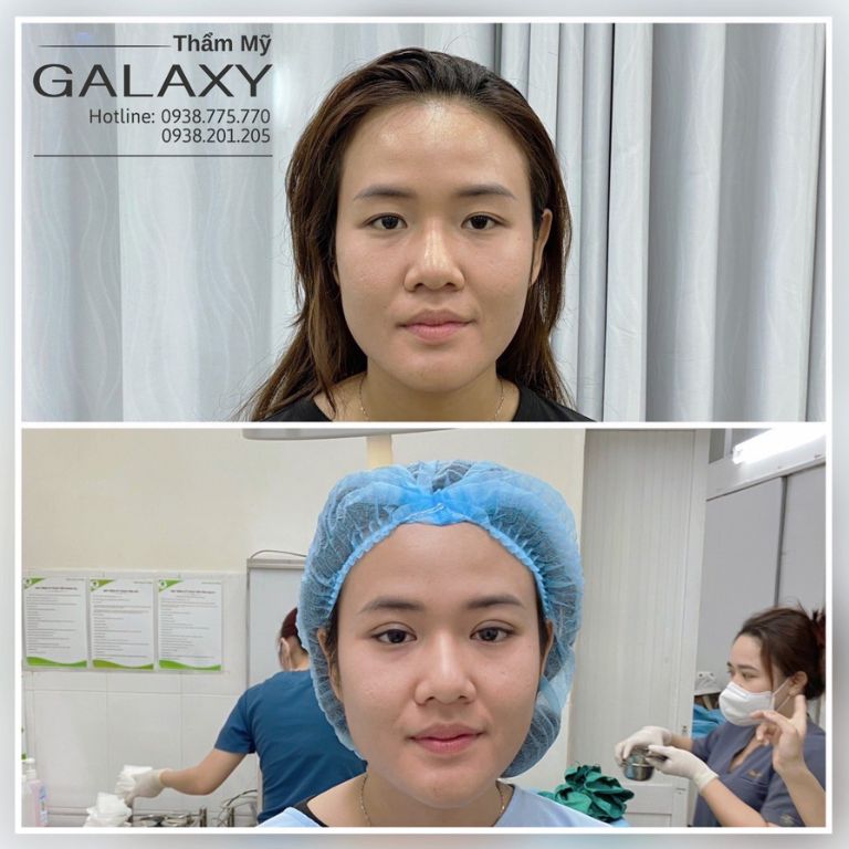 Phẫu thuật Cắt mí – Sụp mí - Sẹo mí mắt miễn phí tại Thẩm mỹ viện Galaxy