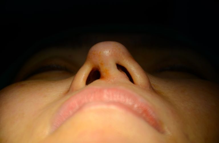 Phẫu thuật miễn phí sửa mũi lệch, tái tạo mũi sau tai nạn