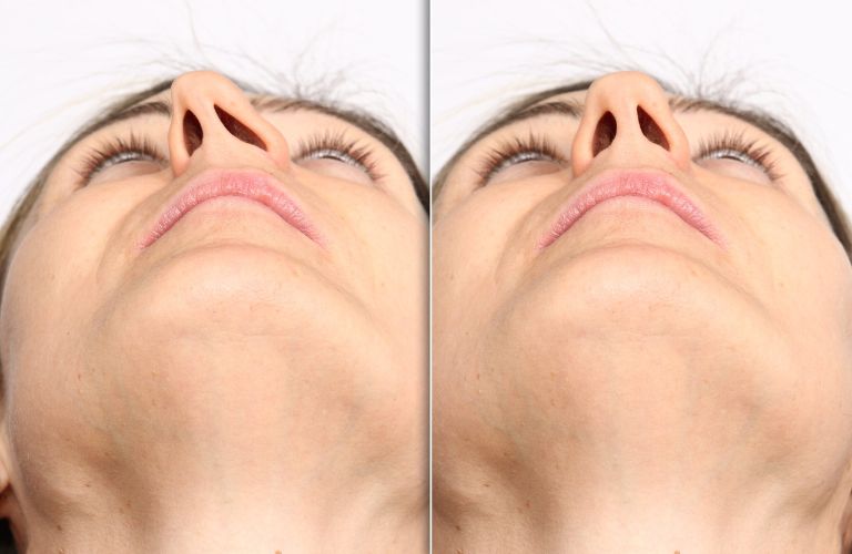 Kết quả sau tái tạo mũi