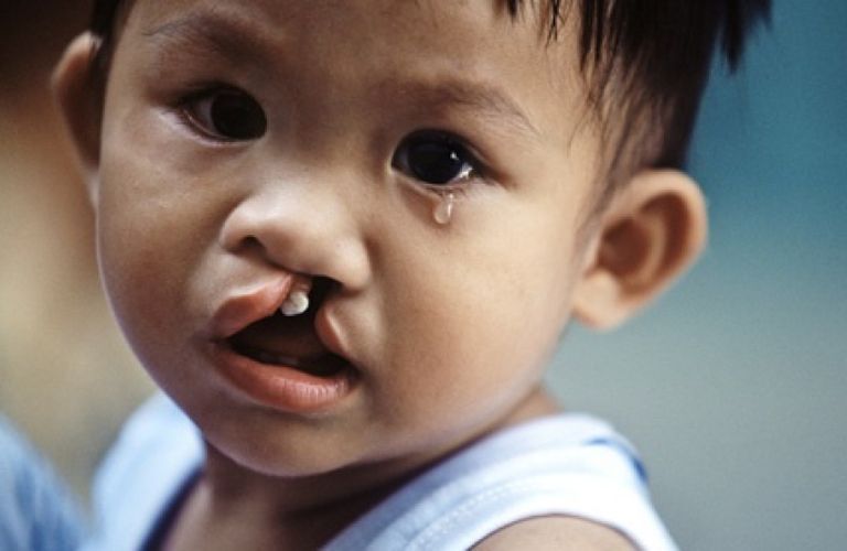 Thẩm mỹ viện Galaxy tái tạo khuôn mặt miễn phí, hồi sinh ước mơ tuổi thơ cho trẻ em