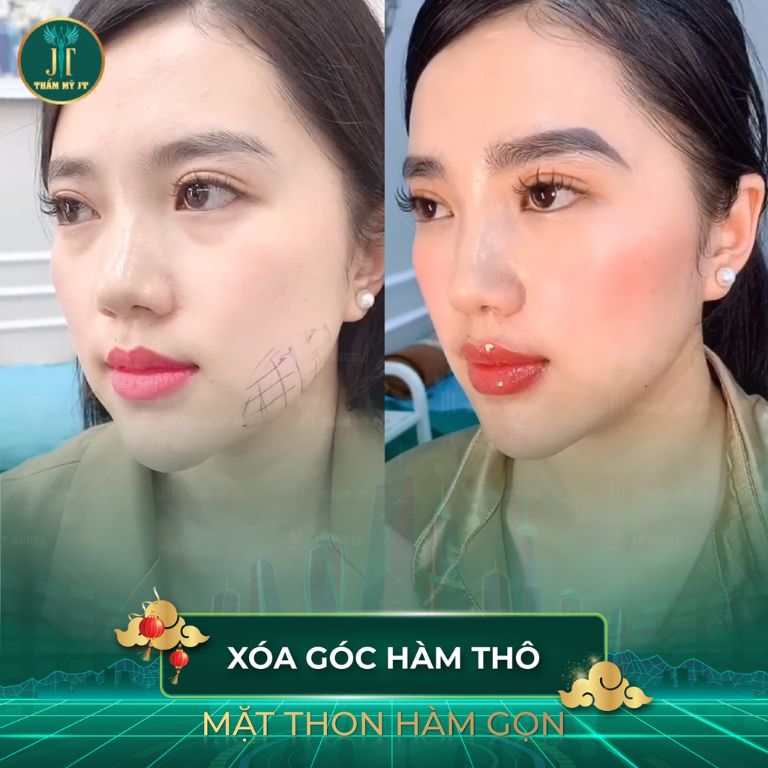 Bệnh viện Thẩm mỹ JT Angel