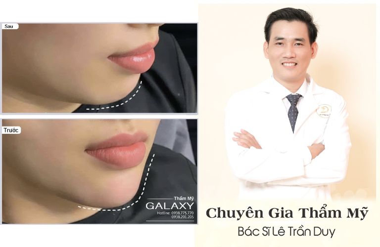 Tiêm Filler với Bác sĩ Lê Trần Duy