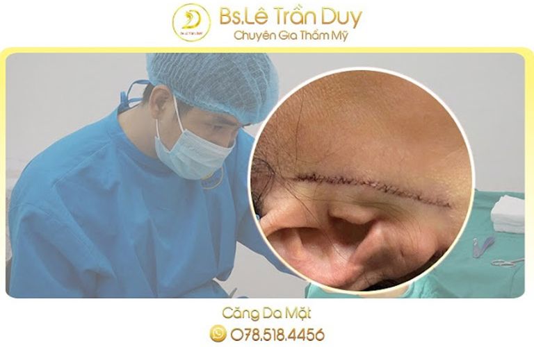 Căng da mặt tại Thẩm mỹ viện Galaxy