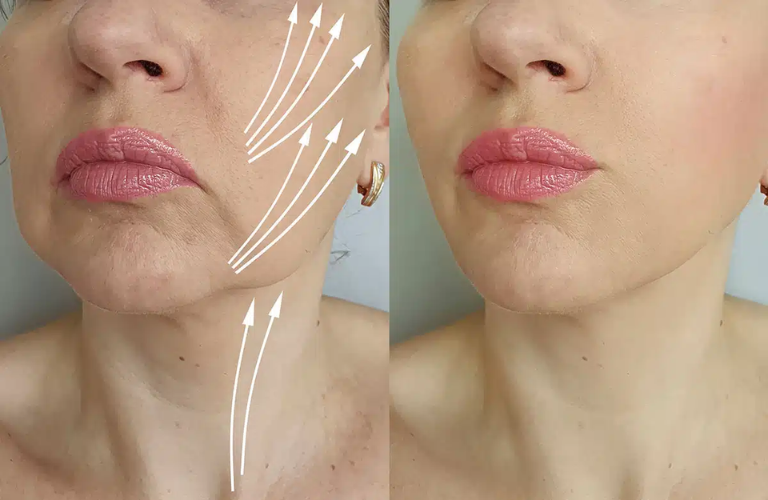 Căng da mặt mini ở TPHCM ngày càng được ưa chuộng