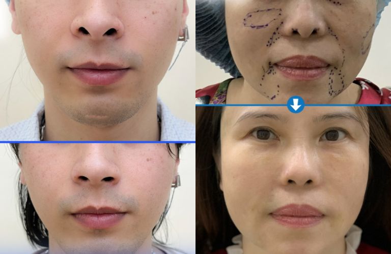 Khuyết hở cánh mũi