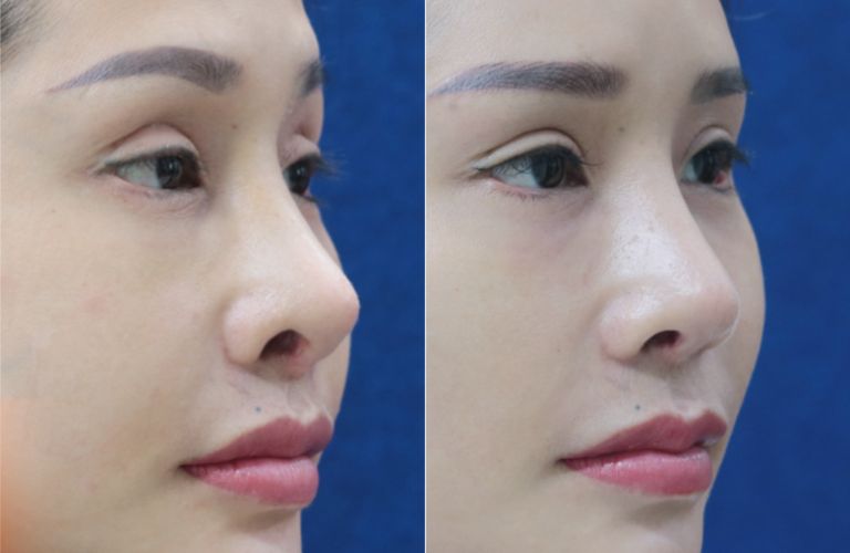 Đắp khuyết hở cánh mũi