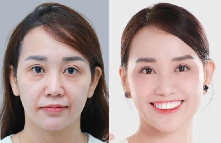 Kích thích sản sinh collagen và elastin tự thân