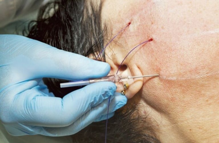 Căng da bằng chỉ collagen tại Thẩm mỹ viện Galaxy