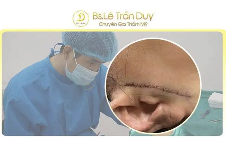 Căng da bằng chỉ vàng với bác sĩ Lê Trần Duy