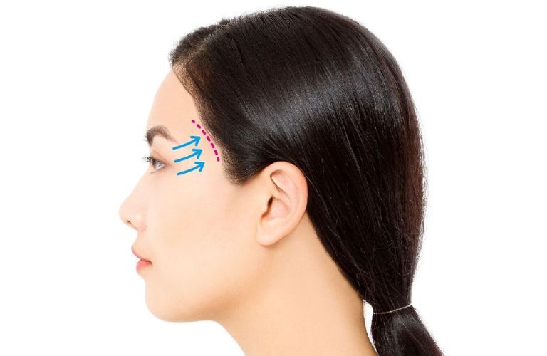 Căng da thái dương