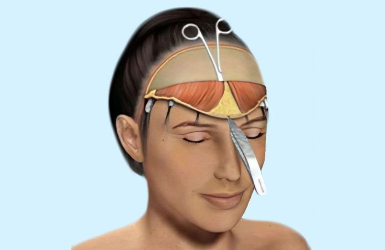 Căng da trán là kỹ thuật can thiệp trực tiếp, cần thực hiện đúng quy trình 