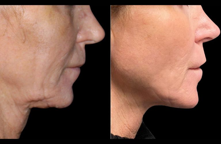 Căng da cổ tại Thẩm mỹ viện Galaxy