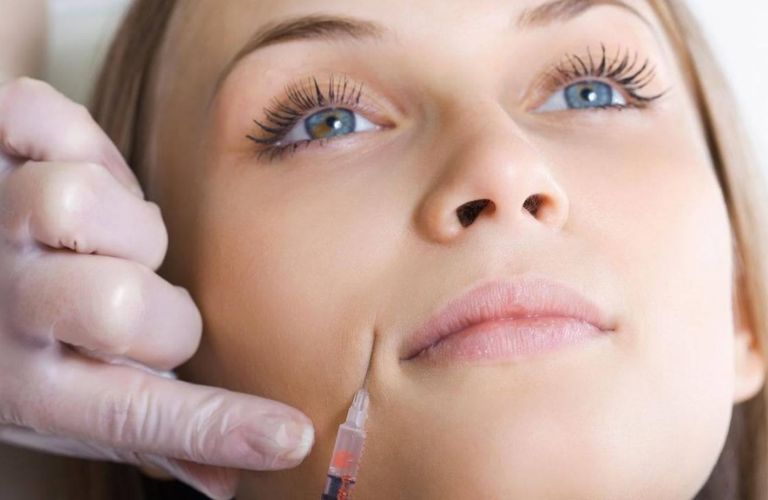 Tiêm Filler xóa rãnh cười