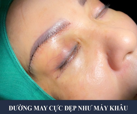 Đường may treo chân mày ở bs lê trần duy