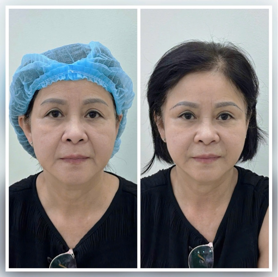 Cô Uyên 65 Tuổi Vừa Treo Chân Mày Xong Đôi Mắt Trẻ Trung Hết Sụp Bụp