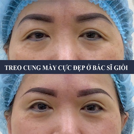 Treo Chân Mày Kỹ Thuật May chống sẹo, mắt hết sụp bụp, trả lại mí mắt như lúc trẻ