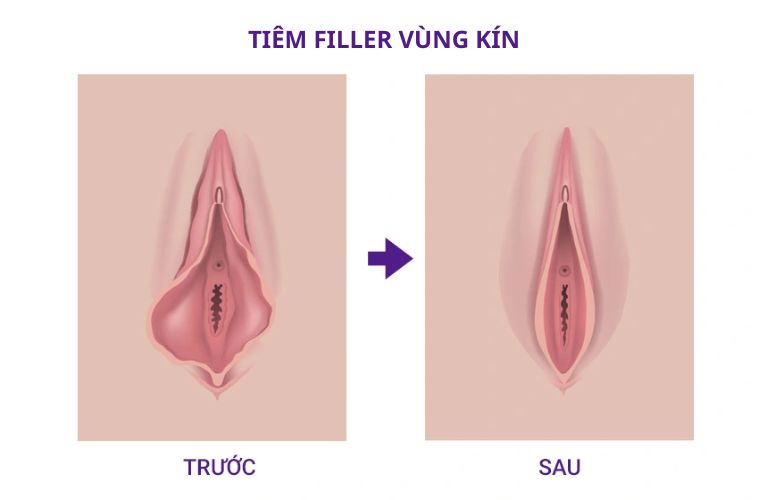 Tiêm Filler vùng kín