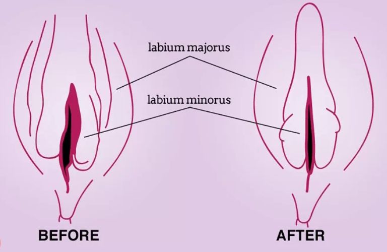 Hỗ trợ trẻ hóa vùng kín mà không cần phẫu thuật